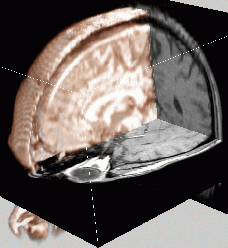 Brain volume rendering