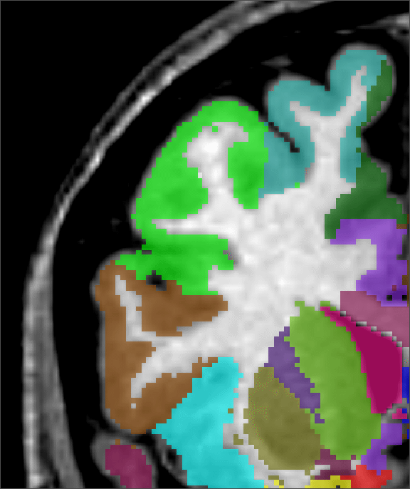 MRI image