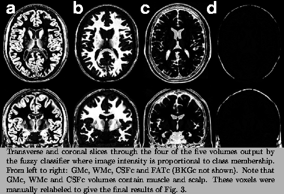 \begin{figure}% latex2html id marker 93
\begin{center}
\centerline{
\epsfxsize=...
...final results
of Fig.~\ref{f:final_phantom}.}
}
\small
\end{center}\end{figure}